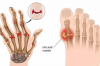 TENNIS ELBOW VÀ VẬT LÝ TRỊ