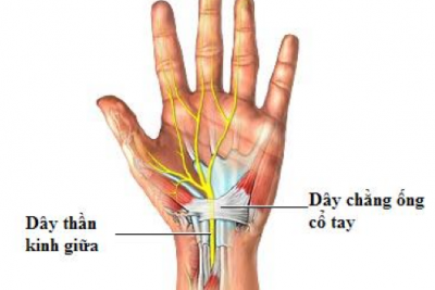 HỘI CHỨNG ỐNG CỔ TAY
