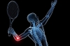 TENNIS ELBOW VÀ VẬT LÝ TRỊ