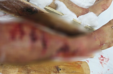 Một người bị chân vịt ca nô chém nhiều nơi trên cơ thể