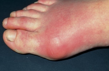 Tại sao người bệnh gout sợ bia hơn rượu?