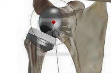 Bệnh viện Nghệ An lần đầu tiên thực hiện thay khớp vai