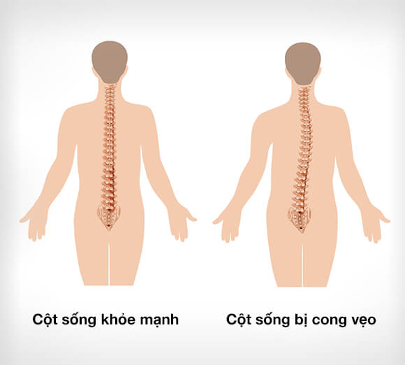 Dieu-tri-cong-veo-cot-song-Maple-Vietnam-3