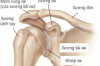 ĐÁNH GIÁ KẾT QUẢ ĐIỀU TRỊ PHẪU THUẬT GÃY 1/3 GIỮA XƯƠNG ĐÒN BẰNG ĐINH KIRSCHNER