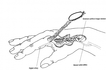 Reverse-Flow First Dorsal Metacarpal Artery Flap for Index Fingertip Reconstruction