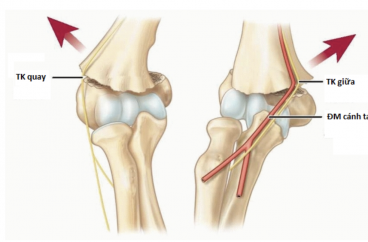 Khảo sát những biến chứng thần kinh kết hợp gãy trên 2 LC trẻ em