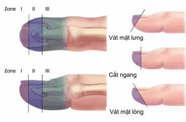 VẠT DA CÓ CUỐNG NGÓN TAY