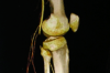 Tổn thương ĐM khoeo trong chấn