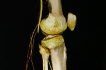 Tổn thương ĐM khoeo trong chấn
