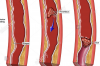 A Case Report: An Acute Thrombus in the Femoral Artery following Total Hip Arthroplasty