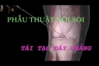 TÁI TẠO DÂY CHẰNG CHÉO TRƯỚC